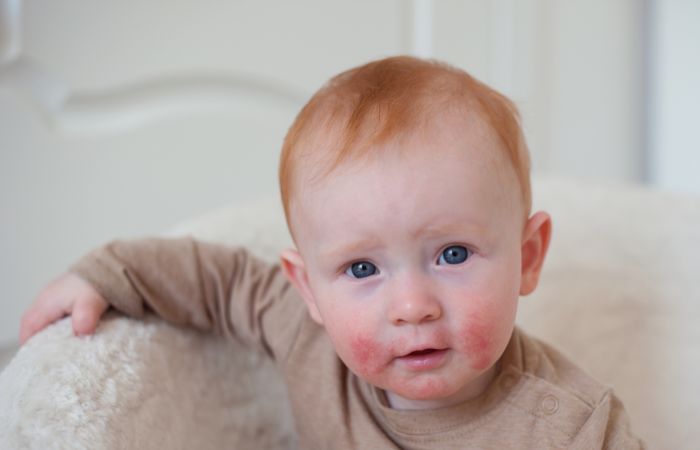 dermatitis atópica