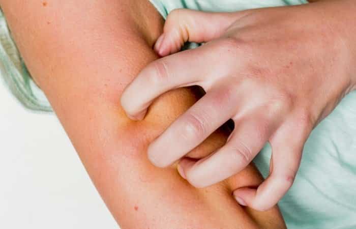 cómo ayudar a nuestro hijo con psoriasis