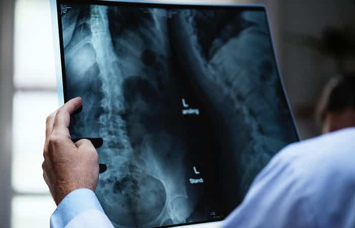 radiografía viendo escoliosis