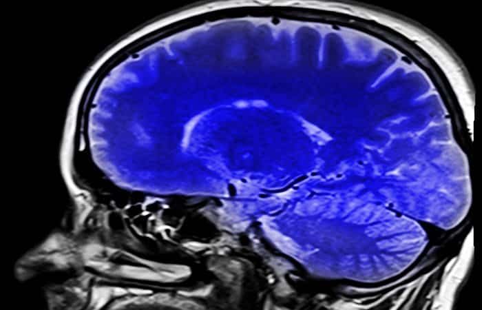Resonancia Magnética Cerebro El aumento de peso perjudica al cerebro, en concreto al córtex