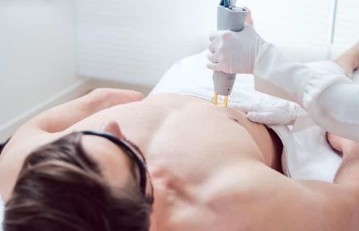 depilación laser