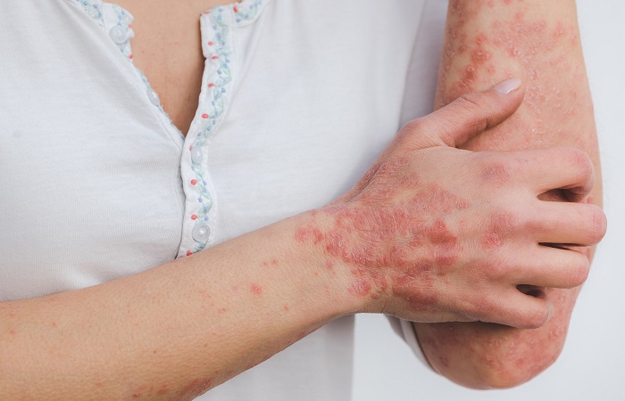 Artritis idiopática juvenil psoriásica