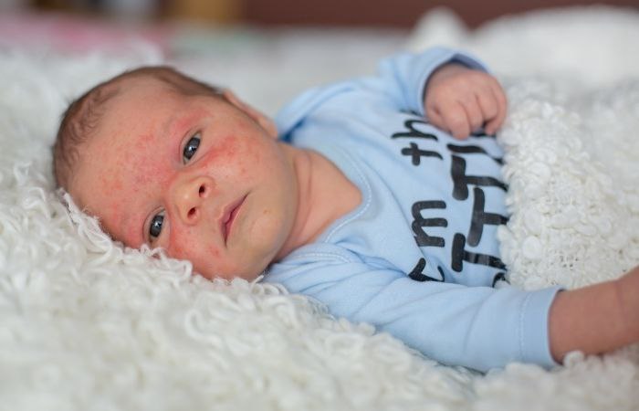 El acné en bebés suele desaparecer por sí solo Acné en bebés y niños