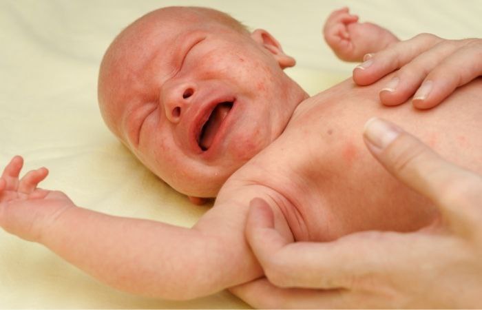 Acné en bebés: causas Acné en bebés: valoración del médico