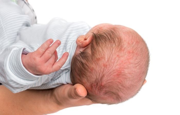 Granitos en el cuero cabelludo Acné en bebés en las primeras semanas de vida