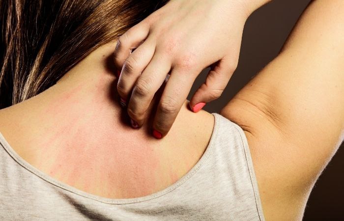 Las alergias alimentarias pueden producir erupciones y picor en la piel Picor en la piel. Diferencias entre alergia e intolerancia