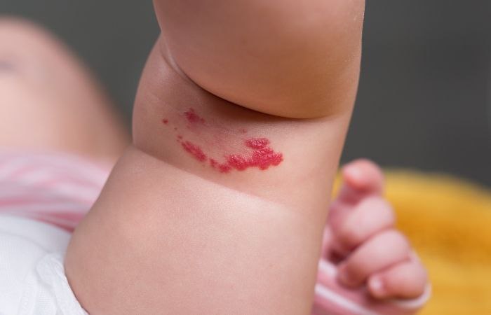 Hemangioma en la pierna del bebé Hemangioma roncha