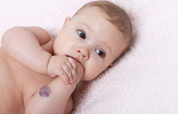 Hemangiomas grandes Hemangioma protuberancia