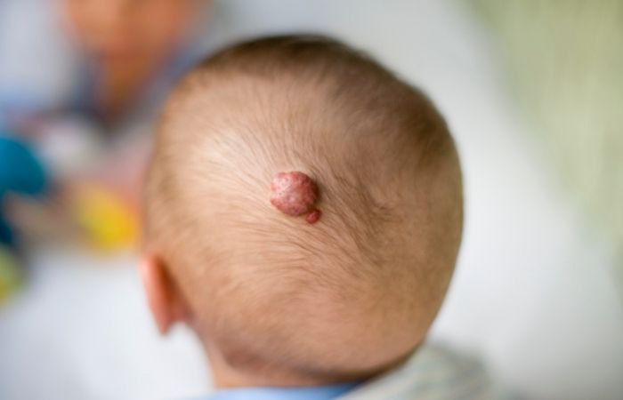 Hemangioma en el cuero cabelludo de un bebé Hemangioma en la piel