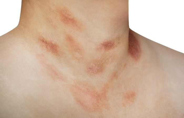 Manchas en el cuello de niños y adolescentes por pitiriasis rosada Pitiriasis rosada en adolescentes