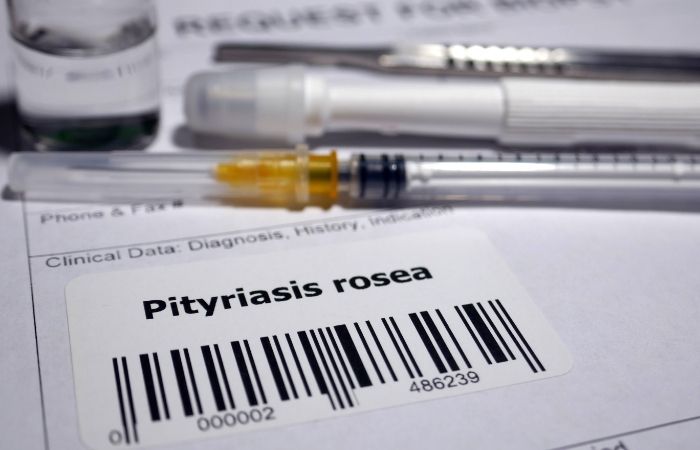 Tratamientos de la pitiriasis rosada en niños Pitiriasis rosada: tratamientos