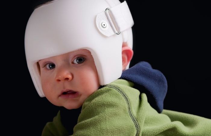 Ortesis o cascos para corregir la malformación del cráneo Síndrome de la cabeza plana: cascos especiales