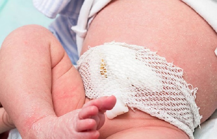 Claves para cuidar el ombligo del recién nacido Cura del ombligo del bebé