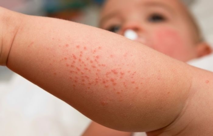 Alergia a la leche: a veces se manifiesta con la aparición de granitos Alergia a la leche: erupciones cutáneas