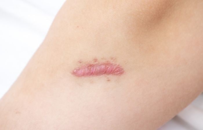 Cicatrices en los niños: aparición de queloides Cicatrices en los niños: queloide