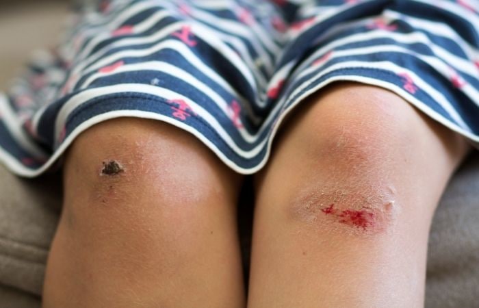 Cicatrices en los niños: heridas en las rodillas, típicas en la infancia Cicatrices en los niños recomendaciones padres