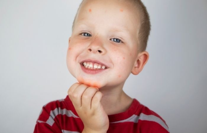 Síndrome del niño burbuja: piel sensible, uno de los síntomas Síndrome del niño burbuja síntomas
