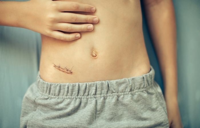 Síntomas de la apendicitis: cicatriz tras la operación Síntomas de la apendicitis cirugía