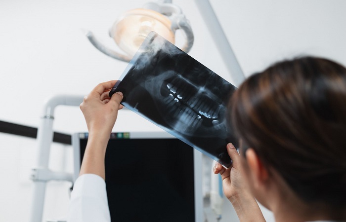 Las radiografías, básicas para diagnosticar la agenesia dental Diagnóstico de la agenesia dental