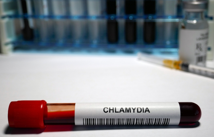 La clamidia es una de las ITS que ha aumentado entre jóvenes ITS entre jóvenes: clamidia